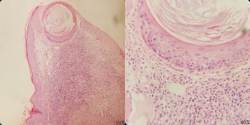 Figure 2 Histopathological assessment of lesions revealing skin tissue with multiple granuloma formation in the subepithelial area composed of epithelioid cells, Langhans giant cell, and lymphocyte around them (Magnifications: 10× and 40×).