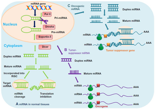 Figure 2 (A–C) Mechanisms of micro-ribonucleic acid (miR) in chordoma. (A) In normal tissues, proper miR transcription, processing, and binding to complementary sequences on the target messenger ribonucleic acid (mRNA) results in the repression of target-gene expression through a block in protein translation or altered mRNA stability. The overall outcomes are normal rates of cellular growth, proliferation, differentiation, and cell death. (B) The reduction or deletion of a “tumor-suppressor miR” due to mutation, deletion, epigenetic modification, or irregularities in miR processing cause inappropriate elevation of miR-target oncoproteins. The overall result might involve increased proliferation, invasiveness, or angiogenesis, decreased levels of apoptosis, or undifferentiated or dedifferentiated tissue, ultimately leading to tumor formation. (C) Amplification or overexpression of an “oncogenic miR” inhibits miR targets of vital tumor-suppressor genes. The overall outcomes are increased cell proliferation, angiogenesis, and metastasis, or augmented chromosomal instability.