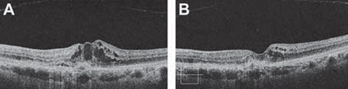 Figure 3. Optical coherence tomography image in a patient with radiation retinopathy following 106Ru brachytherapy for choroidal melanoma. (A) Note the increased foveal retinal thickness with evident cystic spaces. (B) Image of the same patient taken 12 weeks after two intravitreal injections of bevacizumab. Note the significant decreased in the retinal thickness and resolution of the cystic spaces.