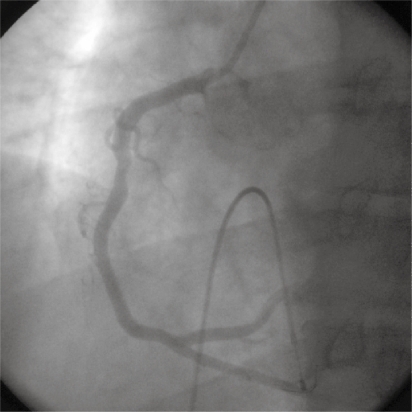 Figure 4 A left anterior oblique view of the right coronary artery after percutaneous intervention.