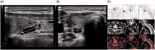 Figure 1. Sonogram of secondary hyperparathyroidism. A 45-year-old woman had been on dialysis for six years, and her ultrasound revealed an enlarged parathyroid gland, with (A) long parathyroid axis, (B) short parathyroid axis, and (C) radionuclide imaging.