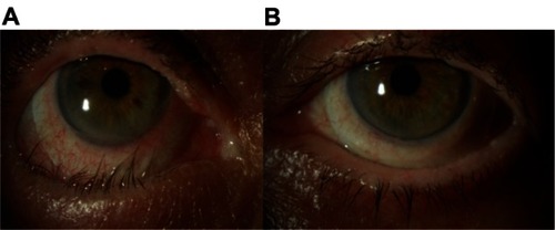 Figure 4 Patient showing a significant difference in clinical appearance of the right and left eyes four months after disease onset. (A) The right eye demonstrates a cicatricial entropion with associated trichiasis and conjunctival injection. A fluid-filled scleral lens (PROSE device) is in place. (B) The left eye demonstrates normal upper and lower eyelid positions without evidence of trichiasis. A PROSE device is also visible.