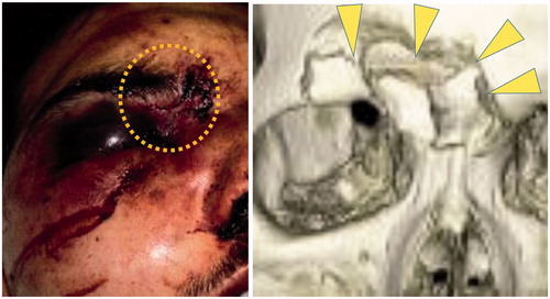 Figure 6. (Left) Judging from the injury pattern of the soft tissue, it is surmised that the upper-medial peri-orbital region was strongly impacted (dotted area). Hence, injury of the optic canal should be suspected. (Right) Destruction of the upper-medial peri-orbital region implies that strong impact worked on this region (triangular arrows). So, optic canal fracture should be suspected.