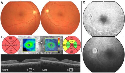 Figure 1 Clinical fundus images of the patient in his 40s. (A) Fundus photographs showing no apparent abnormalities. (B) Horizontal optical coherence tomography (OCT) images showing sustained macular structure whereas the macular maps show diffuse thinning of the entire retinal layers in the macular area. (C) Fluorescence angiography images in the left eye. Both images obtained 50 sec (upper) and 20 min (lower) after injection show no apparent abnormalities.