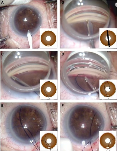 Figure 1 The 360° suture trabeculotomy ab interno procedure.