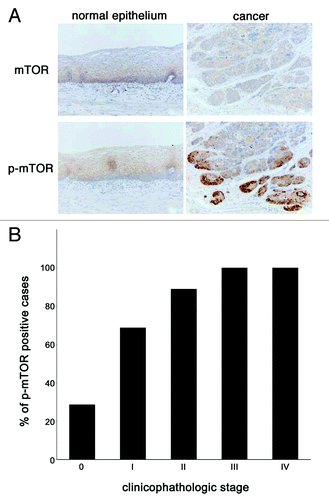 Figure 1. The expression and activation of mTOR is increased in esophageal cancer tissues. (A) Esophageal tissue samples were procured via surgery from the Okayama University Hospital and immunohistochemical analysis of mTOR and phosphorylated mTOR was done to compare its expression status between in cancer tissues (right panels) and in adjacent normal epithelia (left panels). (B) Fifty-eight cases of esophageal cancer whose tissues were used for this immunohistochemistory were categorized according to their pathological staging, which described briefly in “Materials and Methods” section, and the positive staining rate of phosphorylated mTOR in each stage was shown in histogram.