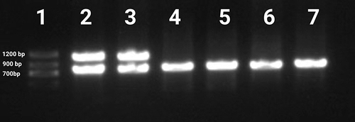 Figure 5 Mutational analysis of the IKBKG gene with PCR analysis of blood samples. Lane 1, Marker; Lane 2, IKBKG deletion exon 4‐10 control; Lane 3, patient; The IKBKG deletion was detected. Lanes 4 and 5 are the father and mother. Lanes 6, big sister; Lanes 7, healthy control.