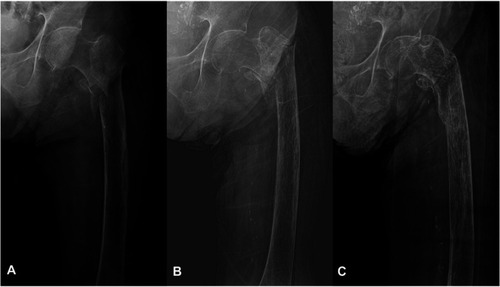 Figure 3 An 84-year-old woman was admitted to the hospital with a transfer fracture in the femur shaft. (A) On simple radiography, the right femur shaft shows a fracture with angulation and shortening. (B) A 10-week radiograph after the sponge cast was applied. (C) An 18-week radiograph after sponge casting, which shows union of the fracture.