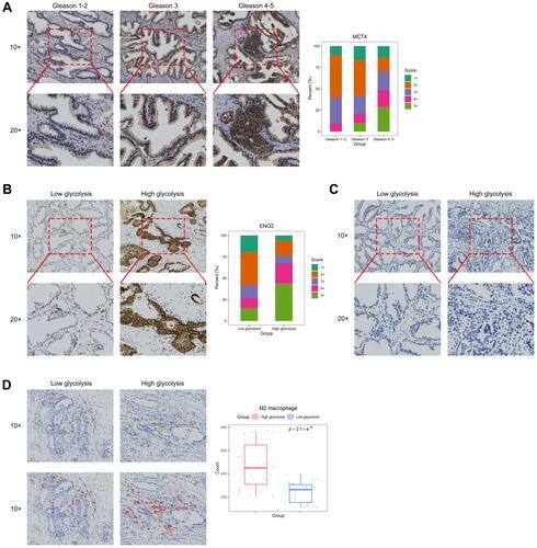 Figure 6 Immunohistochemistry results of MCT4, ENO2, PFKFB3, and CD163. (A) Representative MCT4 immunohistochemical staining patterns in prostate cancer tissues and distribution of MCT4 immunohistochemical staining score in prostate cancer tissues according to Gleason grade. (B) Representative ENO2 immunohistochemical staining patterns in prostate cancer tissues and distribution of ENO2 immunohistochemical staining score in prostate cancer tissues according to glycolysis level. (C) Representative PFKFB3 immunohistochemical staining patterns in prostate cancer tissues. (D) Representative CD163 immunohistochemical staining patterns in prostate cancer tissues with red circles demonstrating the selection of CD163+ cells (M2 macrophages) under low magnification. Box plots showed the number of M2 macrophages in the low- and high-glycolysis groups in the entire prostate cancer tissue specimen.