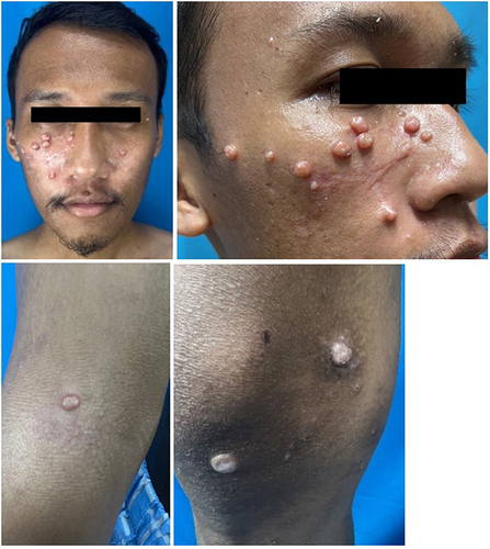 Figure 1 Clinical manifestation of MC lesion on face, right arm, and right leg before therapy.