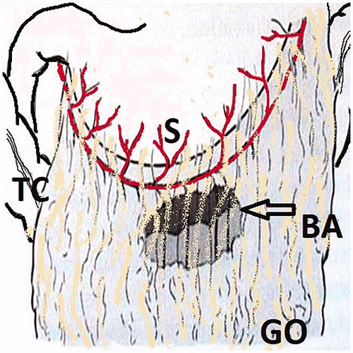 Figure 3. The Bouchet area is a thin and transparent area on the distal side of the gastroepiploic vascular arch. S: Stomach; TC: Transverse Colon; GO: Greater Omentum; BA: Bouchet Area.