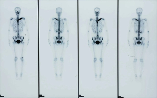Figure 2 99mTc-MDP bone scintigraphy showed an abnormal nuclide concentration in left clavicle region accompanied by left clavicle deformation.