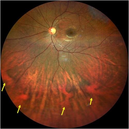 Figure 2 Widefield color fundus image of the left eye in a healthy patient showing the convergence of large choroidal veins to multiple vortex vein ampullae (yellow arrows) in the inferior hemisphere. The location of these ampullae roughly approximate the position of equator of the globe.