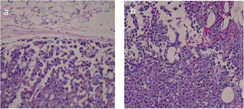 Figure 3. Melanoma tumors were less invasive in older mice that had high three-day running distances compared to mice with low three-day running distances. (a) Representative tumor from a high distance three-day runner in the 20-month age group shows a walled-off noninvasive tumor. (b) Representative tumor from a low distance three-day runner in the 20-month age group shows tumor cells invading space through and beyond the host-response barrier. Tissues were stained with hematoxylin and eosin and examined microscopically at 100 X magnification.