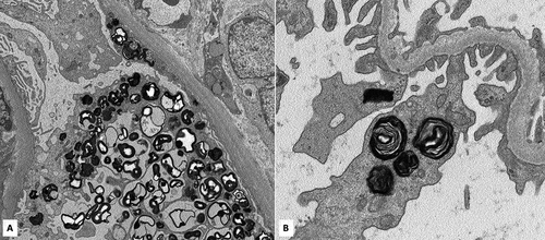 Figure 1. A. Electron microscopy showing myeloid bodies within the podocyte and parietal epithelial cell cytoplasm in a non-FG case (original magnification: 4000×). B. Electron microscopy of the same case shown at higher magnification of myeloid bodies within the podocyte cytoplasm (original magnification: 12000×).