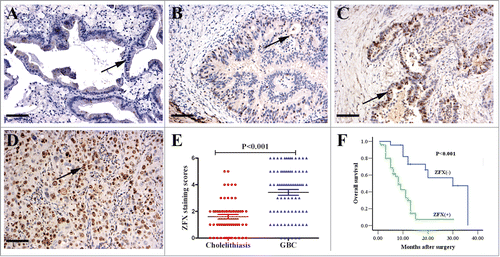 Figure 1. The enhanced expression of ZFX in GBC and negative association with prognosis. ZFX was predominantly localized in the cell nuclei (black arrow, positive staining; scale bar, 100um). (A) Negative staining in normal glandular epithelium. (B) Weak staining in the well differentiated adenocarcinoma. (C) Moderate staining in the partially differentiated adenocarcinoma. (D) Strong staining in the poorly differentiated adenocarcinoma. (E) The average staining scores of cytoplasmic ZFX expression in cholelithiasis and GBC tissues. (F) Kaplan–Meier plots of overall survival in GBC patients with positive and negative ZFX expression scores.