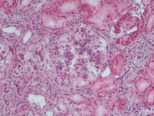 Figure 2 Kidney biopsy performed in 2019. Glomerular enlargement with marked mesangial proliferation and diffuse lobular simplification of the glomeruli. Compared to the first biopsy, the glomeruli showed an accentuated lobular configuration and tubulointerstitial damage (tubular atrophy and fibrosis and inflammation). Hematoxylin eosin, x10.