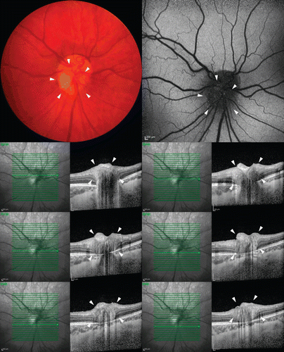 FIGURE 1  Color fundus photograph (top left) shows a yellow fibrotic lesion on the inferonasal portion of the optic disc. Autofluorescence (top right) shows an area of hypoflourescence with punctate hyperfluorescence corresponding to the color photo lesion. EDI-OCT (lower portion) of the involved eye shows a healed heterogeneous hyperreflective mass partially obscuring the optic cup and limiting confirmation that deeper layers of the optic nerve were not affected secondary to shadowing from the lesion’s dense fibrous cap.