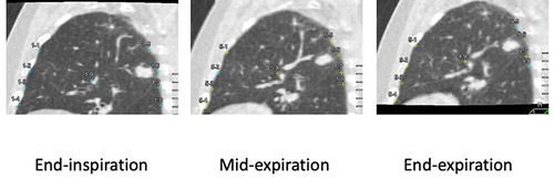 Figure 5 Example images on the median sagittal plane for the left upper lung field for three intermittent time frames in a COPD patient. Median sagittal images for the upper lung field at three intermittent time frames in an 83-year-old male patient with COPD demonstrate smaller movements in the non-dependent pleural aspect compared with the dependent pleural aspect. Moreover, the direction of the movement vector in the non-dependent pleural aspect was caudal. The MPMVND/D in this case had a negative value of −2.71. Colors of some measurement points on the pleural aspects or the lung field center at end-inspiration changed from blue to yellow at mid-inspiration and end-expiration, which means that these yellow points were located outside the displayed median sagittal plane owing to regional lateral movement.