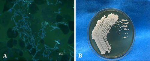 Figure 2 Direct fluorescence microscopy showed blastospores and pseudohyphae (A); On Sabourauds glucose agar at 27°C, cream-colored yeast-like colonies first developed in 3 days (B).