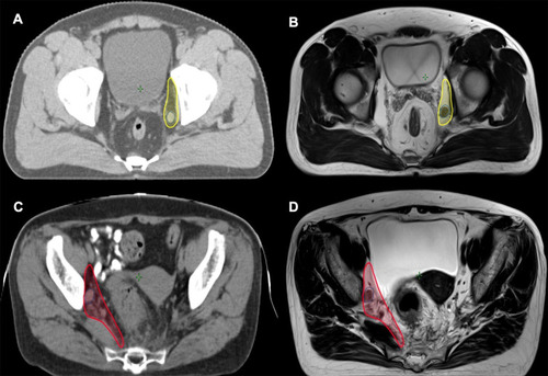 Figure 1 Two examples of clinically positive LPLNs. (A) Atlas of obturator region (yellow) and the clinically positive LPLN (blue) with 9 mm in short axis; (B) the LPLN and obturator region in MRI simulation; (C) atlas of internal iliac region (red) and the clinically positive LPLN (blue) with 11 mm in short axis; (D) the LPLN and internal iliac region in MRI simulation.