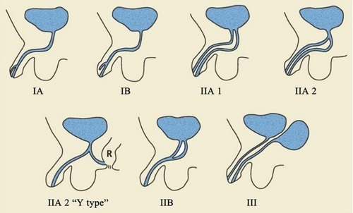 Figure 8 Effman classification system of UD.