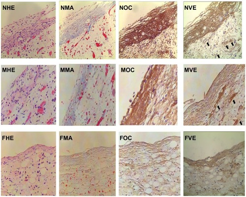 Figure 6 Histomorphometric and immunohistochemical images of peri-implant tissue (400×).Notes: Osteoblastic cells, collagen, osteocalcin, and vascular endothelial growth factor expression were observed in the TiO2 nanotube layer, microporous titanium, and polished titanium plates. More osteoblasts aggregated at the interface of the TiO2 nanotube layers than on the other two groups. Increased staining of collagen, osteocalcin, and vascular endothelial growth factor (black arrow) were observed in TiO2 nanotube layer specimens at 2 weeks. NHE, MHE, and FHE: osteoblastic cells stained by hematoxylin and eosin on the TiO2 nanotube layer, microporous titanium, and flat titanium specimens. NMA, MMA, and FMA: collagen stained by Masson assay on TiO2 nanotube layer, microporous titanium, and flat titanium specimens. NOC, MOC, and FOC: osteocalcin expressed on TiO2 nanotube layer, microporous titanium, and flat titanium specimens. NVE, MVE, and FVE: vascular endothelial growth factor expressed on TiO2 nanotube layer, microporous titanium, and flat titanium specimens.