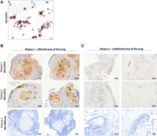 Figure 2 Pathological macrophages are a source of CHIT1 in sarcoidosis. (A) Representative immunocytochemistry for CHIT1 in BALF cells smears from sarcoidosis patients (n = 12); (B and C) Representative images for CHIT1 and AMCase immunohistochemistry of the bronchial mucosa and mediastinal lymph nodes specimens of sarcoidosis patients (n = 15).