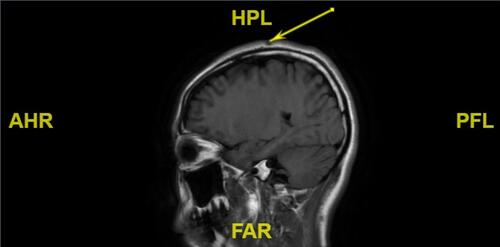 Figure 3 MRI showed local skin sag on the top of her head without invasion of the skull.