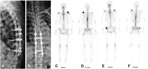 Figure 3 (A) Postoperative lateral X-ray showed 125I brachytherapy seeds implantation and pedicle stabilization with screws. (B) Postoperative anteroposterior X-ray showed 125I brachytherapy seeds implantation and pedicle stabilization with screws. (C) Anterior bone scan at postoperative 10 months. (D) Posterior bone scan at postoperative 19 months. (E) Anterior bone scan at postoperative 19 months. (F) Posterior bone scan at postoperative 19 months. The above bone scan indicated no disease progression at 19 months after surgery.