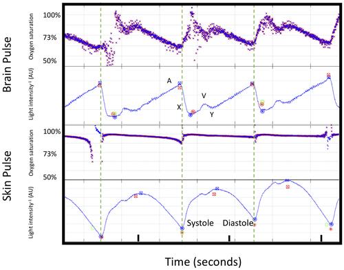 Figure 3 Cardiac cycle changes in oxygen saturations and PPG waveforms (660 nm wavelength shown) for the brain and forehead skin pulse oximeter during normoxia from subject 3. The blood oxygen saturations are demonstrated on the Y axis. The dashed line demonstrates the start of each skin PPG waveform. The brain oximeter oxygen saturations peaked during systole, with a second lower peak during early diastole. Thereafter, oxygen saturations fell. The skin oxygen saturations remained stable throughout the cardiac cycle. The large changes in the brain oximeter oxygen saturations are consistent with the signal arising from microcirculation blood. The changes in the skin are consistent with shunting, and blood bypassing the capillaries.Abbreviation: AU, arbitrary units.