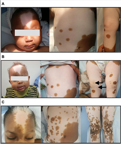 Figure 1 Regression of piebaldism-related depigmented body patches during the growth period of the patient. (A) At 3 months old, the patient presented with a distinct triangularly shaped depigmentation pattern of forehead and white forelock (WF) of hair (left), large depigmented patches in the abdomen with some patches and macules with normal pigmentation (middle), and a large depigmented patch on the right lower limb with some normal pigmented macules and patches (right). (B) At 8 months of age, the WF manifestation remained unchanged, indicating pigmentation absence (left); the abdominal skin features also remained unchanged, indicative of pigmentation absence (middle); however, the lower limbs started to show signs of pigmentation with the development of new hyperpigmented macules (black arrows, right). (C) At the age of 7 years, the skin of the WF showed signs of pigmentation (especially at the periphery of the lesion) but the hair remained white in color; furthermore, additional café-au-lait macules appeared as hyperpigmented patches (left), the abdominal skin area showed massive pigmentation in the depigmented patch (middle), and pigmentation on both lower limbs was noticeable (right).