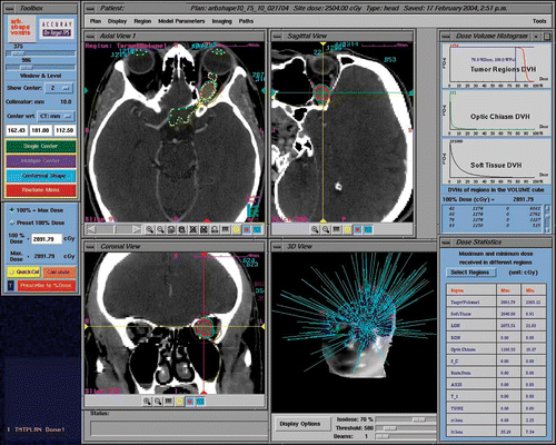 Figure 2. Treatment planning for patient I. CT imaging shows a contrast-enhancing globular lesion growing eccentrically to the left optic nerve, which is compressed and displaced. Treatment planning details such as dose delivered and DVHs are illustrated.