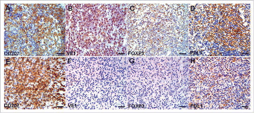 Figure 3. IHC for CD207, VE1, FOXP3, and PDL1 in serial sections of two representative LCH cases. (A–D) Case 1 had LCH with BRAF V600E mutation. (B) VE1, diffusely strong cytoplasmic staining; (C) FOXP3, moderate, focally strong nuclear staining; (D) PDL1, diffusely strong cell membrane and cytoplasmic staining. (E–H) Case 2 had LCH with wild-type BRAF V600E. (F) VE1, negative; (G) FOXP3, negative; (H) PDL1, weak cell membrane and cytoplasmic staining. Original magnification ×40, scale bar = 20 μm.