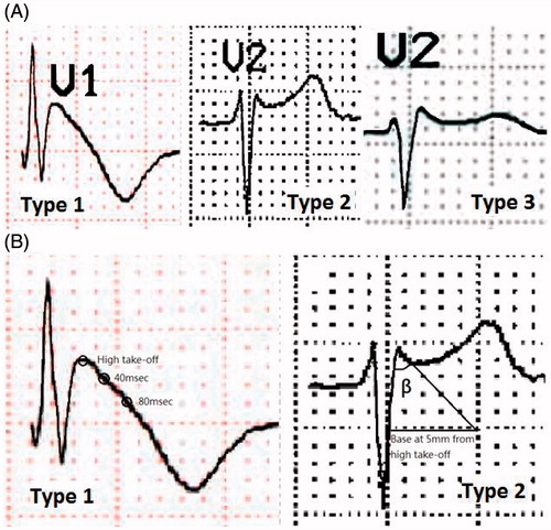 Figure 1. Comparisons of the HRS/EHRA/APHRS 2013 and ISHNE 2012 Brugada syndrome ECG criteria. (A). HRS/EHRA/APHRS 2013: Type 1 ECG (coved type); type 2 ECG (saddleback type); type 3 ECG (saddleback with ST-segment elevation <1 mm). (B). ISHNE 2012: Type 1 ECG (coved pattern); type 2 ECG (saddleback pattern) with β angle >58°. ECG = electrocardiographic; HRS/EHRA/APHRS = Heart Rhythm Society/European Heart Rhythm Association/Asia-Pacific Heart Rhythm Society; ISHNE = International Society for Holter and Noninvasive Electrocardiography.