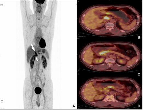Figure 2 PET-CT scan results for the patients before treatment. (A) There existed strengthened FDG activity at the gastric antrum and proximal duodenum (upper arrow: gastric antrum and proximal duodenum, lower arrow: tumor thrombus of the portal vein). (B–D) Transverse views of the PET-CT image indicated strengthened tracer uptake in gastric antrum (B), left gastric vein (C) and hepatic portal vein (D).