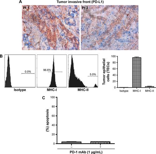 Figure S1 Information on primary tumor.Notes: (A) PD-L1 staining on 5 μM tumor sections utilized for TECs’ isolation. (B) MHC-I/II staining of isolated TECs shown by flow cytometry, and (C) apoptotic effect of CD8+ T cells on TECs (MSS).Abbreviations: TECs, tumor epithelial cells; Pt, patient; MSS, MMR proficient; MMR, mismatch repair.