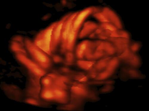 Figure 8 Three dimension power (3D) Doppler imaging of complex umbilical cord entanglement in monochorionic monoamniotic twins at 27 weeks’ gestation. The monoamniotic twins depicted in Figure 6–8 were delivered by emergency Cesarean at 29 and 1/7 weeks’ gestation, due to prolonged fetal bradycardia of twin B (60 bpm for 14 minutes), one day after admission for continuous fetal heart rate monitoring and intramuscular rescue steroids to decrease overall prematurity-associated neonatal morbidities should premature delivery become indicated. At delivery, marked entanglement of the umbilical cords and complex umbilical cord entanglement of twin B (a true knot and nuchal cord), were noted. Birth weights were 1195 and 1385 grams, respectively; Apgar scores were 5/7/9 and 6/8/9 at 1, 5 and 10 minutes, respectively, and umbilical artery gas analyses; pH = 7.27 base excess = −3.4 and 7.22 and −4.6, for twins A and B, respectively. Both infants did well.