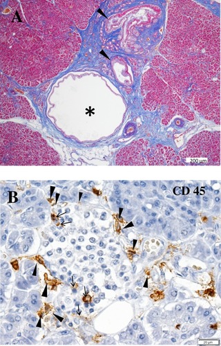 Figure 1 Characteristic features of the pancreas in patients with SPIDDM. (A) Pancreatic intraductal papillous neoplasia (PanIN) lesion frequently observed in the patients with SPIDDM. Azan staining. PanIN lesion of pancreatic ducts (arrowheads) is associated with an atrophied, fibrous pancreatic lobe (stained blue), a dilated pancreatic duct (asterisk) and extensive mononuclear cell infiltration. (B) Insulitis in a patient with SPIDDM. CD45 (leukocyte common antigen) + mononuclear cells (MNCs) are infiltrated around (arrowheads) and into the islet cells (arrows). Most of the CD45+ cells are CD8+ T cells and CD68+ macrophages. Aida K, Fukui T, Jimbo E, et al. Distinct inflammatory changes of the pancreas of slowly progressive insulin-dependent (Type 1) Diabetes. Pancreas. 2018;47(9):1101–1109.Citation21