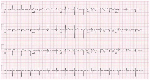 Image 1. EKG: T wave inversion in anterior-lateral and inferior leads