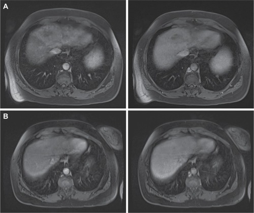 Figure 2 Interval MRI images from Case 1.