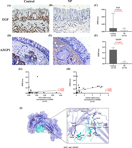 Figure 5 The location distribution, expression and interaction of EGF and AZGP1 protein. (A) The expression of EGF protein by IHC in control. (B) The expression of EGF protein by IHC in CRSwNP. (C) The semi-quantity of EGF protein expression in control compared with in CRSwNP by the average optical density value. (D) The expression of AZGP1 protein by IHC in control. (E) The expression of AZGP1 protein by IHC in CRSwNP. (F) The semi-quantity of AZGP1 protein expression in control compared with in CRSwNP by the average optical density value. (G) The correlation between the expression of EGF mRNA and protein. (H) The correlation between the expression of AZGP1 mRNA and protein. (I) EGF (the cyan model) is docked into AZGP1 (the slate model) through hydrogen bonding interactions and their binding sites are shown as pink stick structures. P-values < 0.05 was considered statistically significant.