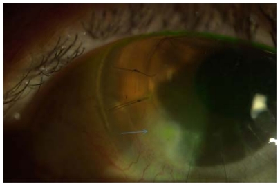 Figure 2 Slit lamp photo showing ulcer and infiltrate in corneal graft, after removal of suture (blue arrow).