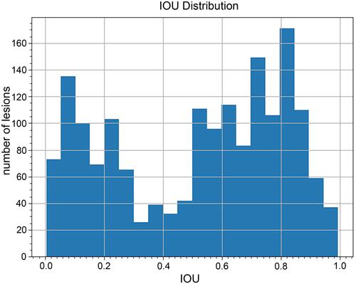 Figure 2 IOU distribution for all lesions. As shown in this figure, there are two peaks in the distribution, which means most predictions may have high IOU value or very low IOU value, and the average IOU is 0.7894.
