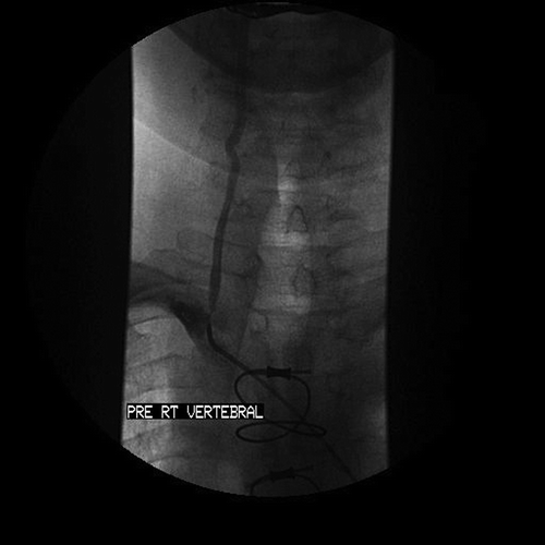 Figure 1 Selective‘roadmap’ angiogram before the percutaneous intervention showing a critical ostial lesion in the dominant right vertebral artery.