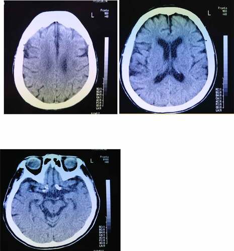 Figure 1. Brain computed tomography image of an 84-year-old woman shows mild cortical atrophy in the hippocampus and the absence of a cerebrovascular lesion.