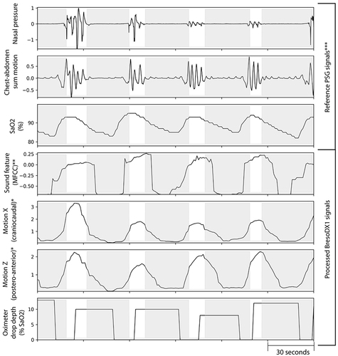 Figure 3 An example of extracted features from BresoDX1 recordings compared to reference nasal pressure, the sum of chest-abdominal motion and SaO2 from polysomnography (PSG) during intermittent apneas highlighted by shading. *Motion signals from BresoDX1 are normalized; **Mel-frequency cepstral coefficients (MFCC) have arbitrary units. ***Reference signals from PSG are normalized from arbitrary units.