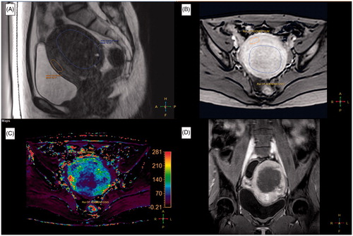 Figure 1. A 39-year-old woman with a 138 ml adenomyosis was treated with magnetic resonance imaging (MRI)-guided high-intensity focussed ultrasound (HIFU) ablation. (A) A sagittal T2-weighted (T2W) MR image of the adenomyosis prior to HIFU treatment. (B) A quantitative perfusion MR image was analyzed by drawing a region of interest (ROI) within the area of the adenomyosis lesion and the myometrium on one of the perfusion MR images. (C) The generated Ktrans map. (D) A contrast-enhanced T1-weighted (CE-T1W) MR image obtained immediately after MRI-guided HIFU treatment.