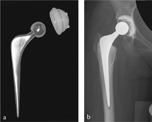 Figure 1a. Example of a cemented total hip arthroplasty with polyethylene cup and polished stem. 1b. Radiographic appearance.
