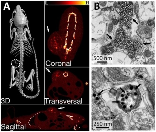 Figure 10 (A) X-ray CT images of the tumor-bearing mice after intratumoral injection of NP/PDA suspension. Reproduced with permission from Dai Y, Yang D, Yu D, et al. Mussel-inspired polydopamine-coated lanthanide nanoparticles for NIR-II/CT dual imaging and photothermal therapy. ACS Appl Mater Interfaces. 2017;9(32):26674– 26683.Citation186 Copyright American chemical society 2017. (B) Electron micrographs of UCNPs distributed in the neuronal tissue. Black arrows indicate clusters of UCNPs. Top image shows the distribution of most UCNPs in extracellular space, and the bottom image shows the uptake of UCNPs within an axon. From Chen S, Weitemier AZ, Zeng X, et al. Near-infrared deep brain stimulation via upconversion nanoparticle–mediated optogenetics. Science. 2018;359(6376):679.Citation187 Reprinted with permission from AAAS https://science.sciencemag.org/content/359/6376/679.